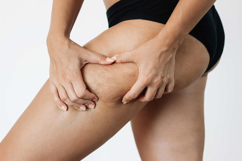 Cellulite